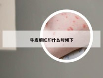 牛皮癣红印什么时候下