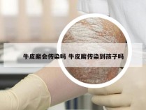 牛皮廨会传染吗 牛皮廨传染到孩子吗