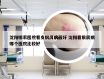 沈阳哪家医院看皮银屑病最好 沈阳看银屑病哪个医院比较好