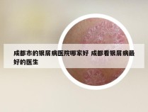 成都市的银屑病医院哪家好 成都看银屑病最好的医生