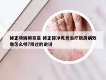 修正顽固癣克星 修正藓净乳膏治疗银屑病效果怎么样?用过的说说