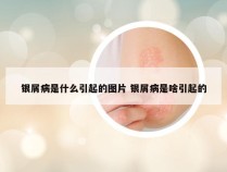 银屑病是什么引起的图片 银屑病是啥引起的