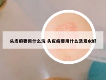 头皮癣要用什么洗 头皮癣要用什么洗发水好