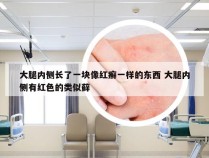 大腿内侧长了一块像红癣一样的东西 大腿内侧有红色的类似藓