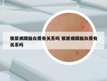 银屑病跟脑白质有关系吗 银屑病跟脑白质有关系吗