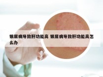 银屑病导致肝功能高 银屑病导致肝功能高怎么办