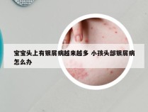 宝宝头上有银屑病越来越多 小孩头部银屑病怎么办