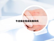 牛皮癣会变成白癜风吗