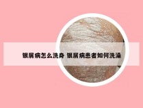 银屑病怎么洗身 银屑病患者如何洗澡