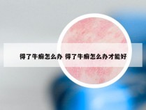 得了牛癣怎么办 得了牛癣怎么办才能好