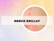 癖癣癖药高 癖病怎么治疗