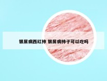 银屑病西红柿 银屑病柿子可以吃吗