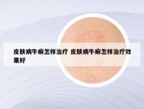 皮肤病牛癣怎样治疗 皮肤病牛癣怎样治疗效果好