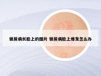 银屑病长脸上的图片 银屑病脸上爆发怎么办