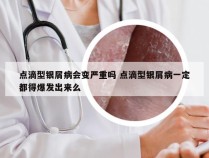 点滴型银屑病会变严重吗 点滴型银屑病一定都得爆发出来么