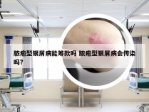 脓疱型银屑病能筹款吗 脓疱型银屑病会传染吗?