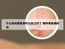 什么样的银屑病可以自己好了 哪种银屑病好治