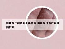 他扎罗汀和达力士牛皮癣 他扎罗汀治疗银屑病扩大