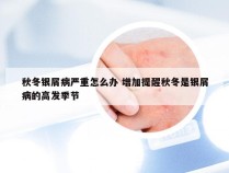 秋冬银屑病严重怎么办 增加提醒秋冬是银屑病的高发季节