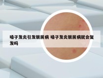 嗓子发炎引发银屑病 嗓子发炎银屑病就会复发吗