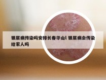 银屑病传染吗安排长春华山l 银屑病会传染给家人吗