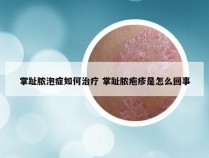 掌趾脓泡症如何治疗 掌趾脓疱疹是怎么回事