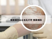 银屑病怎么让毛孔打开 银屑病扣