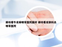 廊坊看牛皮癣哪家医院最好 廊坊看皮肤科去哪家医院