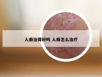 人癣治得好吗 人癣怎么治疗