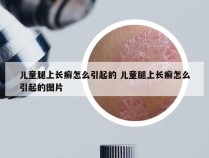 儿童腿上长癣怎么引起的 儿童腿上长癣怎么引起的图片