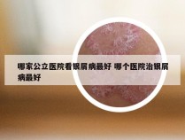 哪家公立医院看银屑病最好 哪个医院治银屑病最好