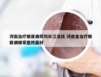 河南治疗银屑病荐刘长江当找 河南省治疗银屑病哪家医院最好