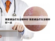 银屑病治疗方法哪种好 银屑病治疗方法哪种好一点