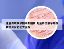 儿童白斑病早期诊断图片 儿童白斑病早期症状图片合肥北大医院