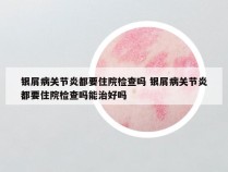 银屑病关节炎都要住院检查吗 银屑病关节炎都要住院检查吗能治好吗