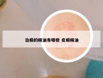 治癣的精油有哪些 皮癣精油