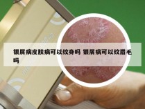 银屑病皮肤病可以纹身吗 银屑病可以纹眉毛吗