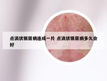 点滴状银屑病连成一片 点滴状银屑病多久会好