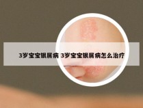 3岁宝宝银屑病 3岁宝宝银屑病怎么治疗