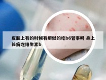 皮肤上有的时候有癣似的吃b6管事吗 身上长癣吃维生素b