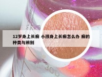 12岁身上长癣 小孩身上长癣怎么办 癣的种类与辨别