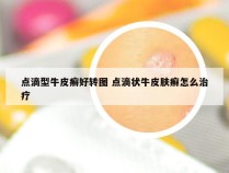 点滴型牛皮癣好转图 点滴状牛皮肤癣怎么治疗