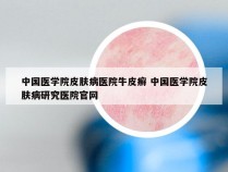 中国医学院皮肤病医院牛皮癣 中国医学院皮肤病研究医院官网