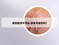 癣到底传不传染 癣有传染性吗?