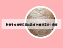 长春牛皮癣哪家医院最好 长春哪家治牛癣好