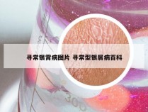 寻常银霄病图片 寻常型银屑病百科