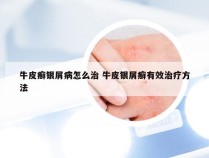 牛皮癣银屑病怎么治 牛皮银屑癣有效治疗方法