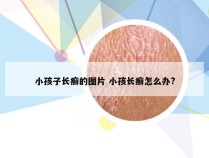 小孩子长癣的图片 小孩长癣怎么办?