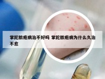 掌跎脓疱病治不好吗 掌跎脓疱病为什么久治不愈