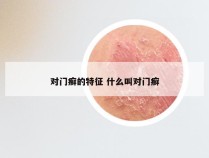 对门癣的特征 什么叫对门癣